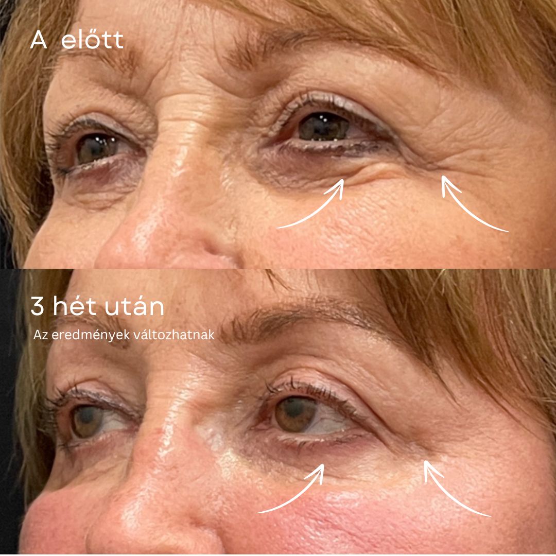 GlowLift Retinol Szemkörnyékápoló Stift